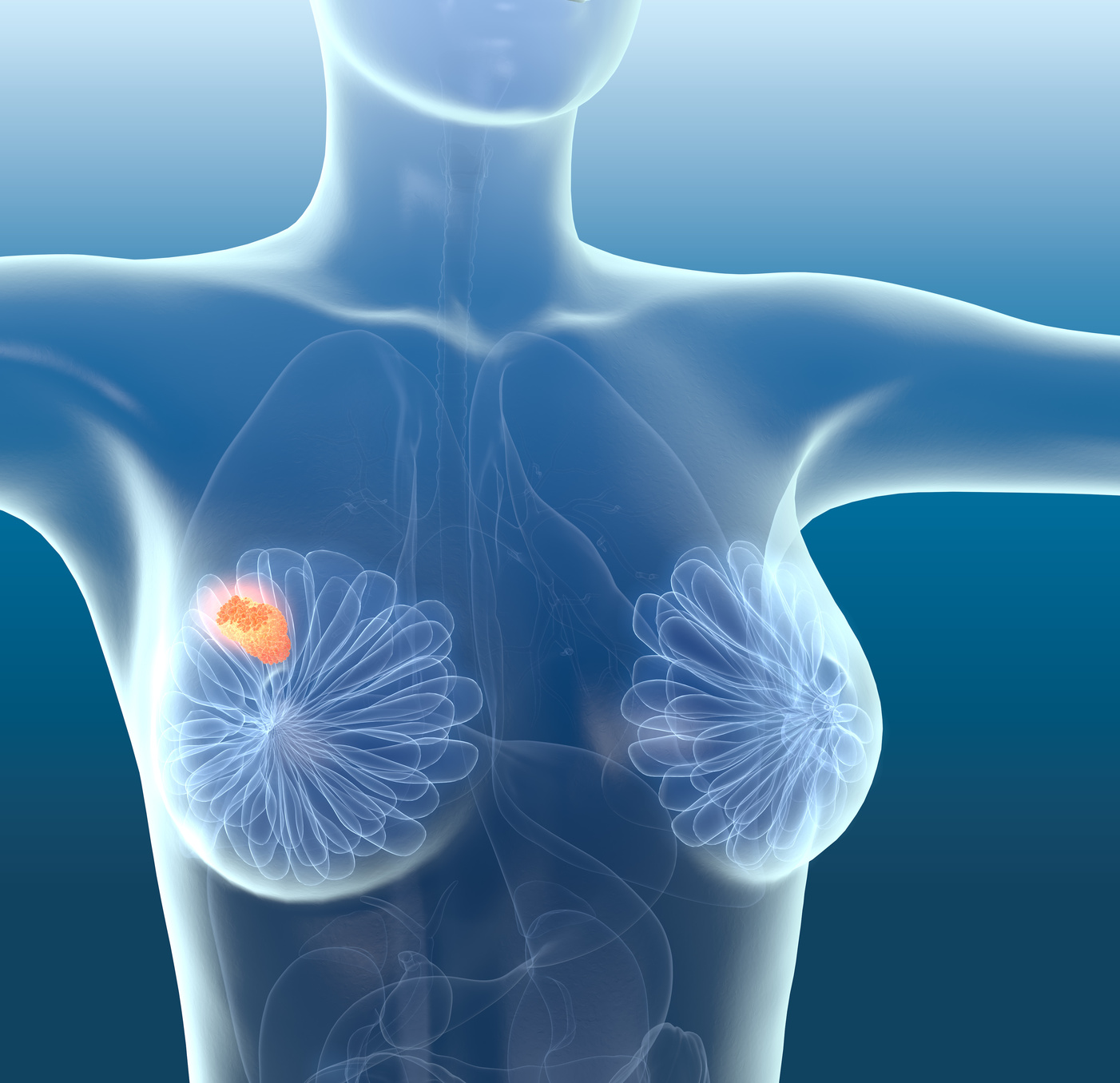 доброкачественные опухоли в груди у женщин фото 5